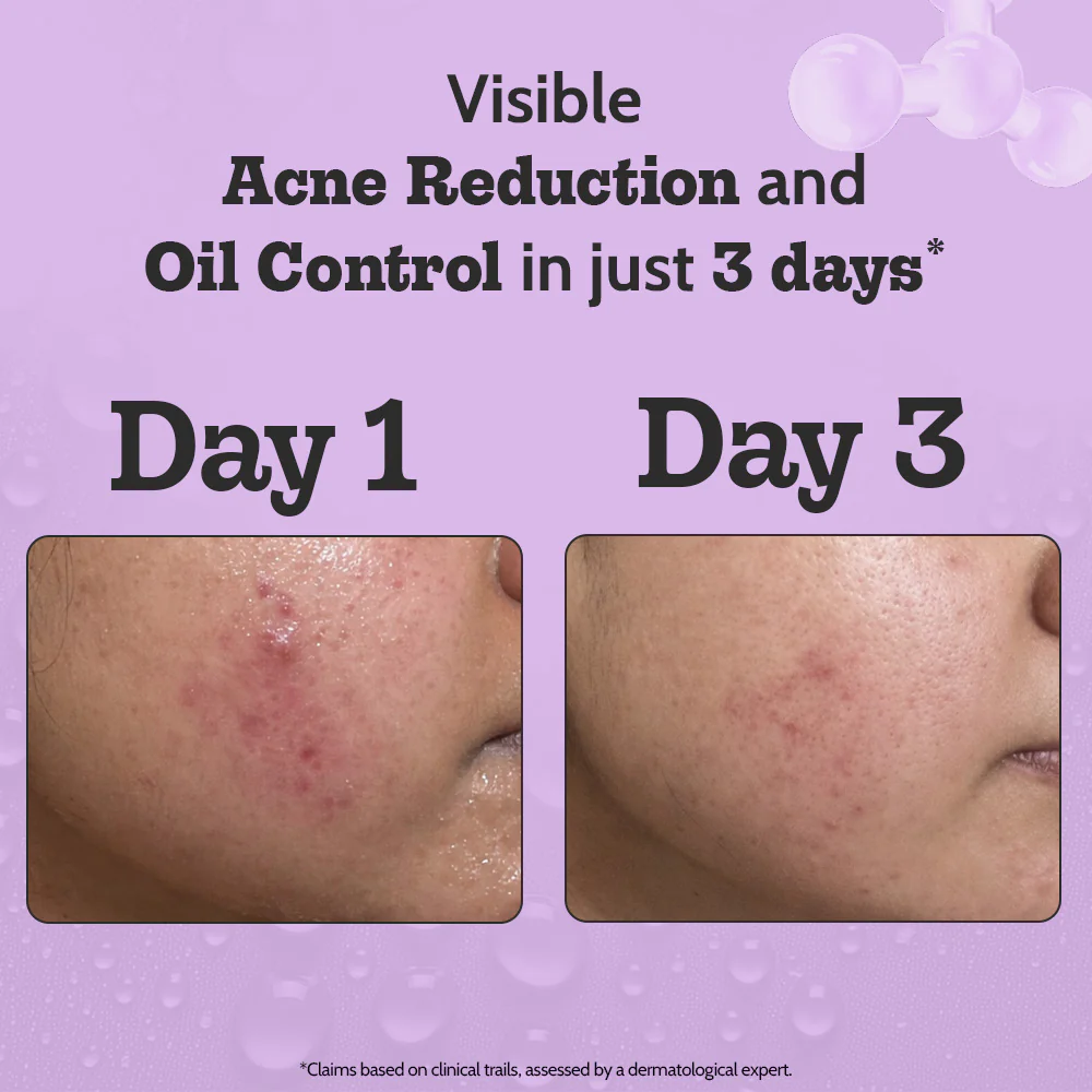 2% Salicylic Acid Face Serum for Acne Control - 10 ml - Image 3