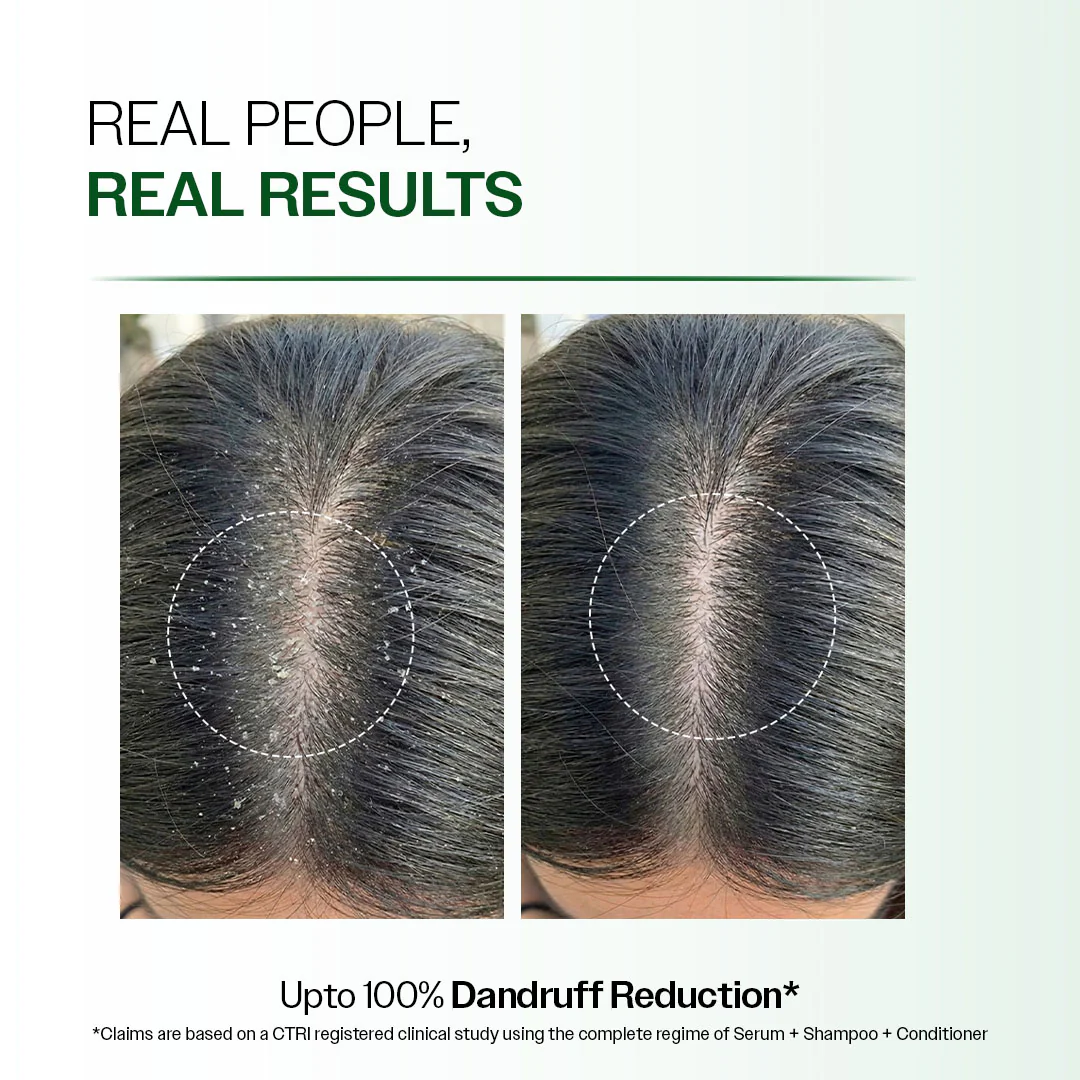 Advanced Anti Dandruff Serum with Salicylic Acid & Pentavitin - 50 ml - Image 4
