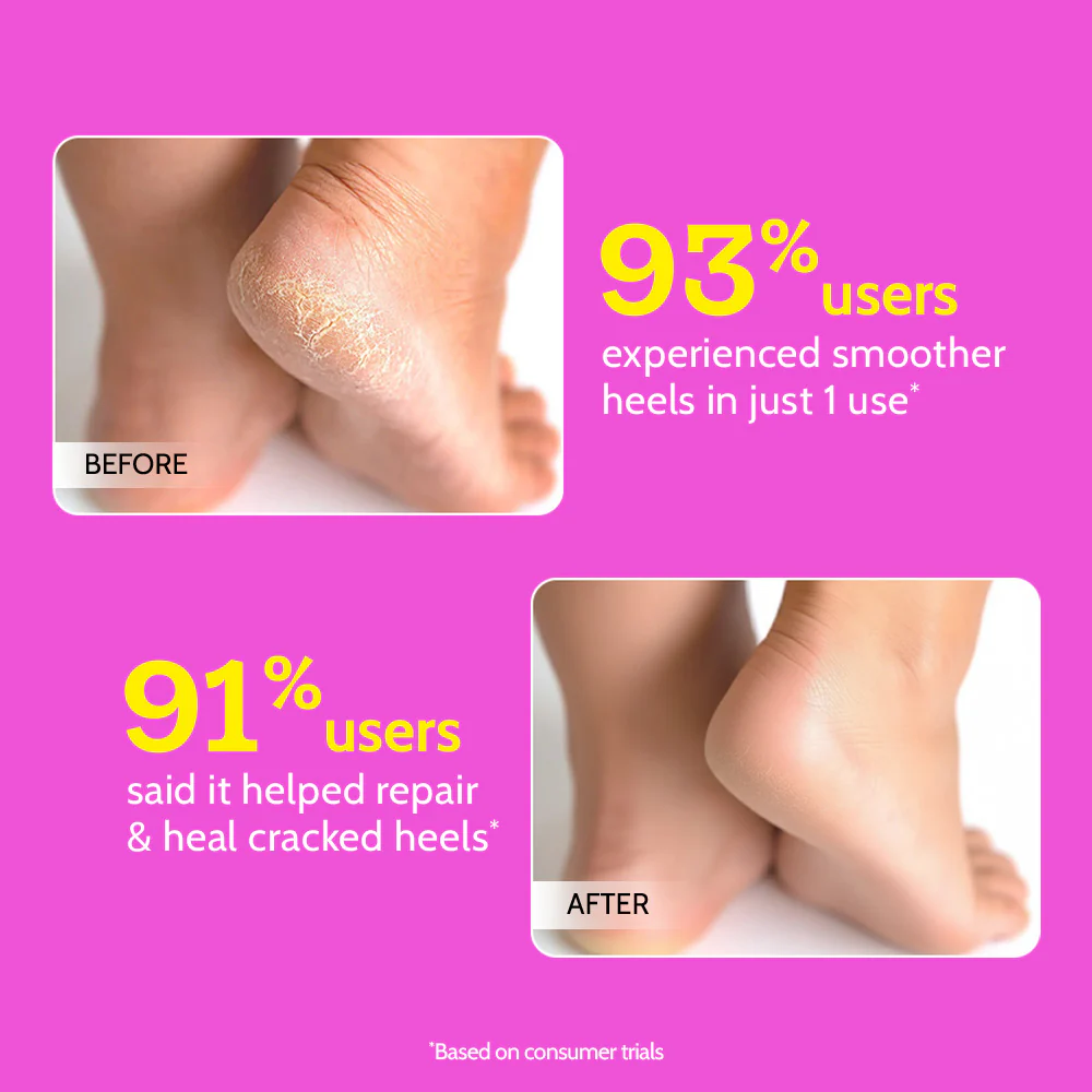 Foot Roll-on for Cracked Heels & Diabetic Foot - 50 gm - Image 6